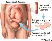 diabet Diabetul Gestational