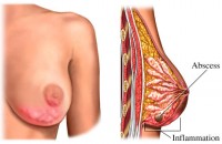 Mastita – inflamarea sanilor
