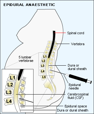 anestezia epidurala