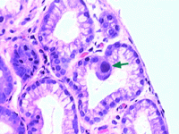 citomegalovirus