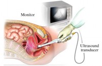 ecografia-transvaginala