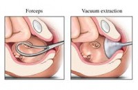forceps-extractie cu vacuum