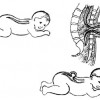 spina-bifida