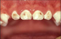 Cariile dentare la copii: cauze, tratament si prevenire. Ata dentara