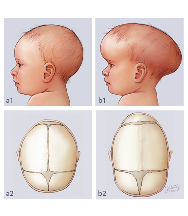 craniosinostoza