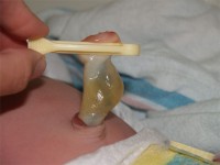 chist-de-gelatina-wharton