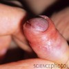 Phimosis