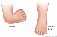 comparatie-varus-equin-picior-normal