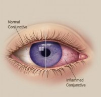 conjunctiva